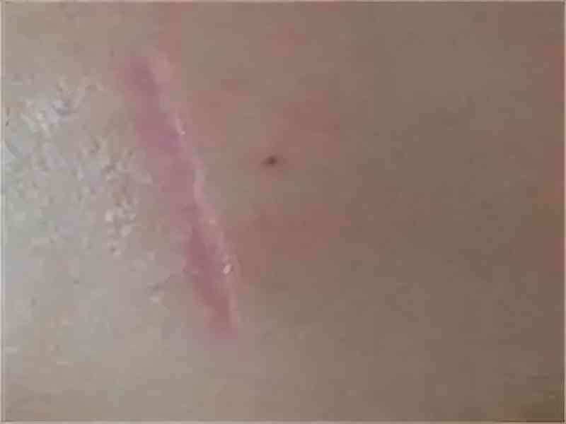 良心国货化妆品消疤(国货祛疤膏)插图9