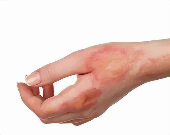 良心国货化妆品消疤(国货祛疤膏)插图10