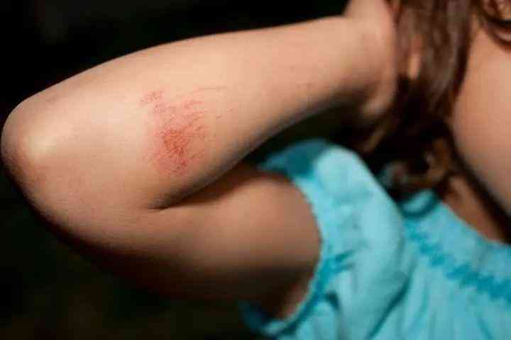 良心国货化妆品消疤(国货祛疤膏)插图11