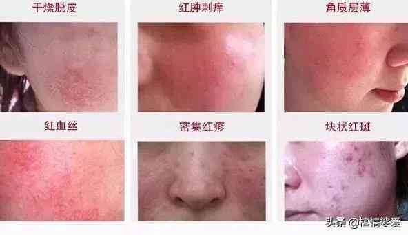 用含激素的化妆品的危害(用含激素的化妆品有什么危害)插图3