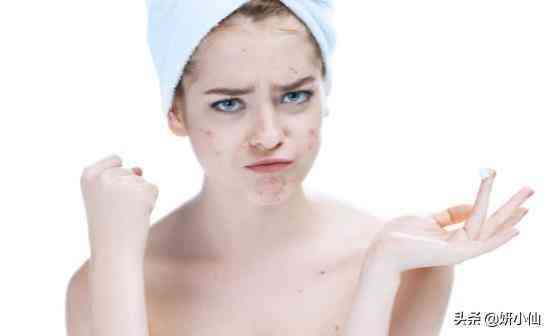 下巴上的粉刺化妆品(下巴粉刺用什么)