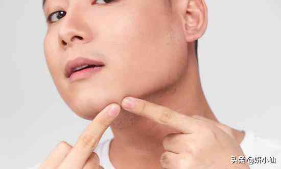 下巴上的粉刺化妆品(下巴粉刺用什么)插图1