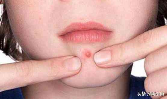 下巴上的粉刺化妆品(下巴粉刺用什么)插图2