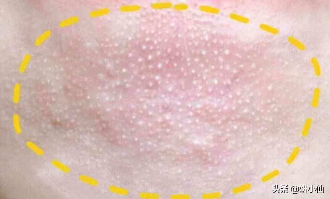 下巴上的粉刺化妆品(下巴粉刺用什么)插图3