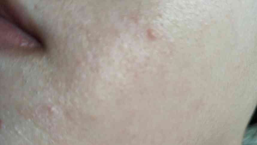 用好化妆品为啥起痘(用好化妆品为啥起痘痘)