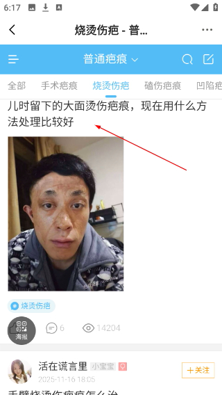 疤痕论坛